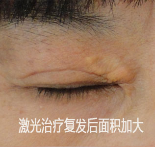 特色 睑黄瘤   采用激光治疗睑黄瘤是近年来很多医院的一种替代技术
