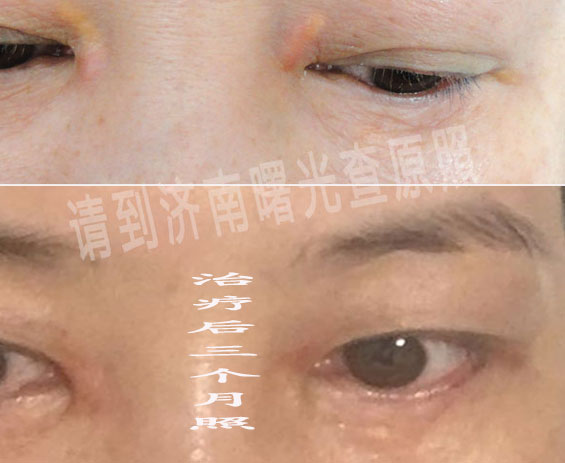特色 睑黄瘤_济南曙光美容整形医院官方网站