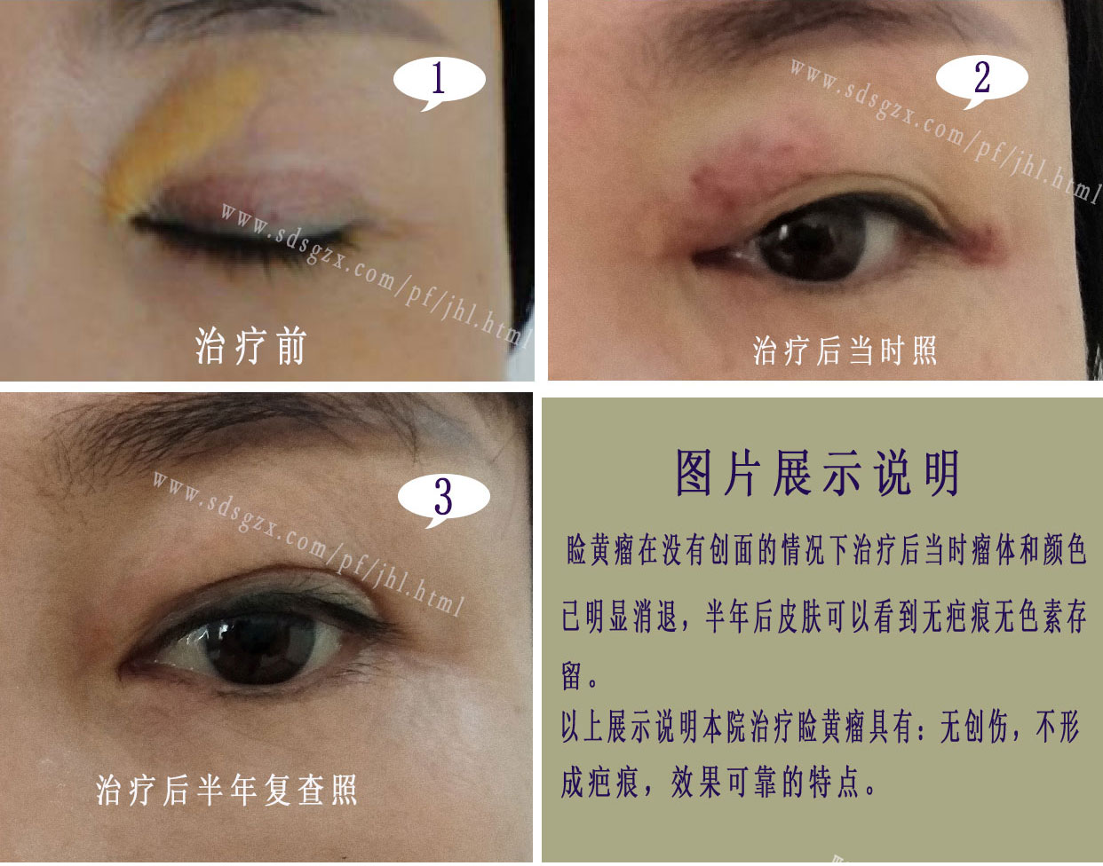 治療眼皮黃斑瘤 - Premier Clinic